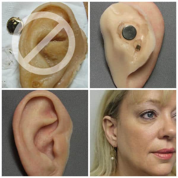 A person 's ear with an injury on it.