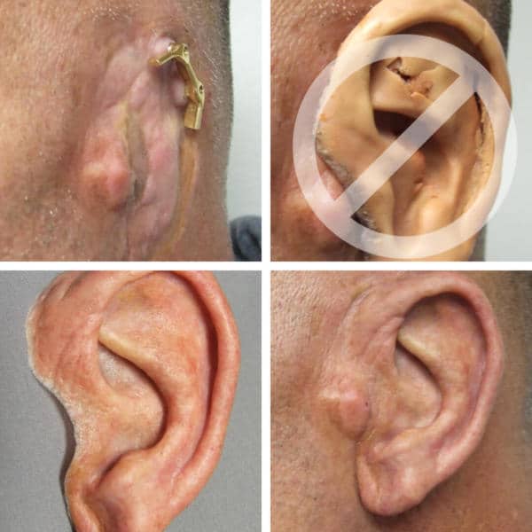 A person 's ear with an injury on it.