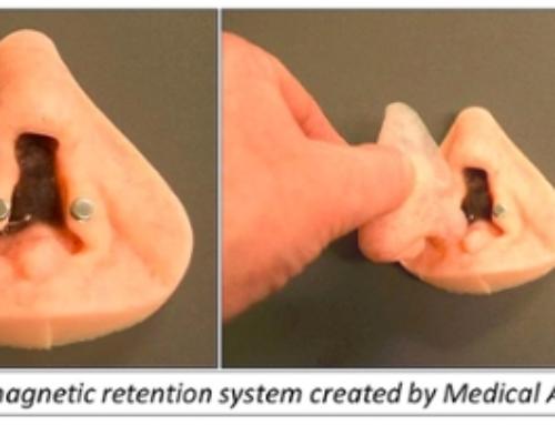 Craniofacial Prosthesis at Northwestern University Prosthetics-Orthotics Center