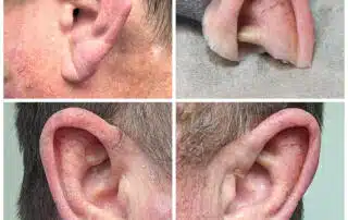 A man with different ear lobe and ear lobe problems.