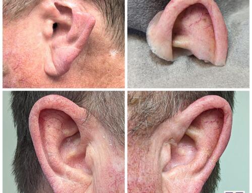 Upper Ear Prosthesis for our Kansas Veteran