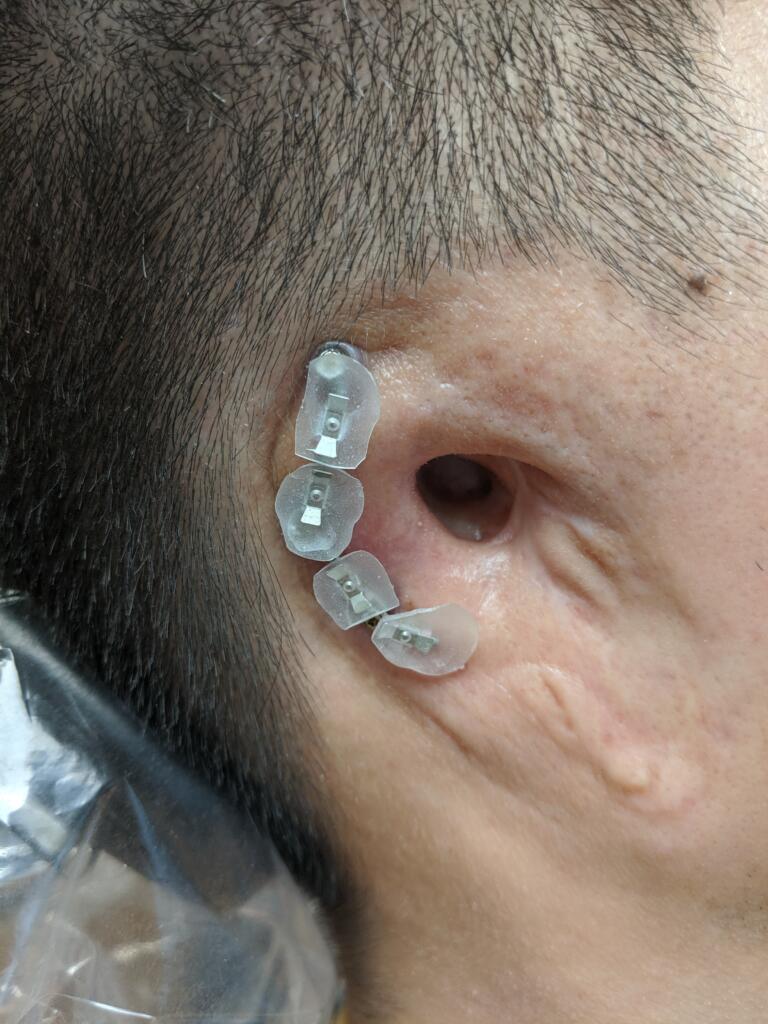 A person 's ear with an injury on it.
