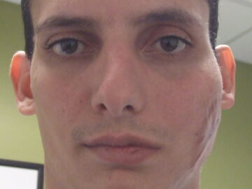 prosthetic ear on a man illuminated from the back