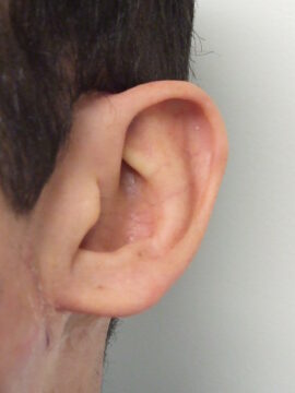 a close up photo of an ear prosthesis